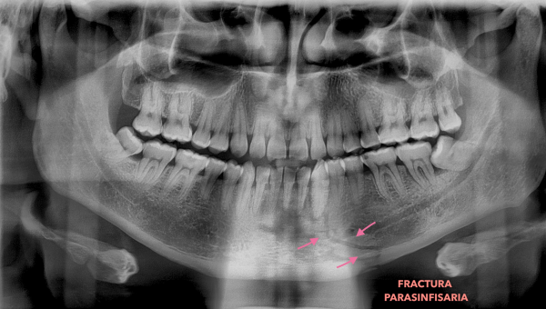 Caso interesante de fractura mandibular